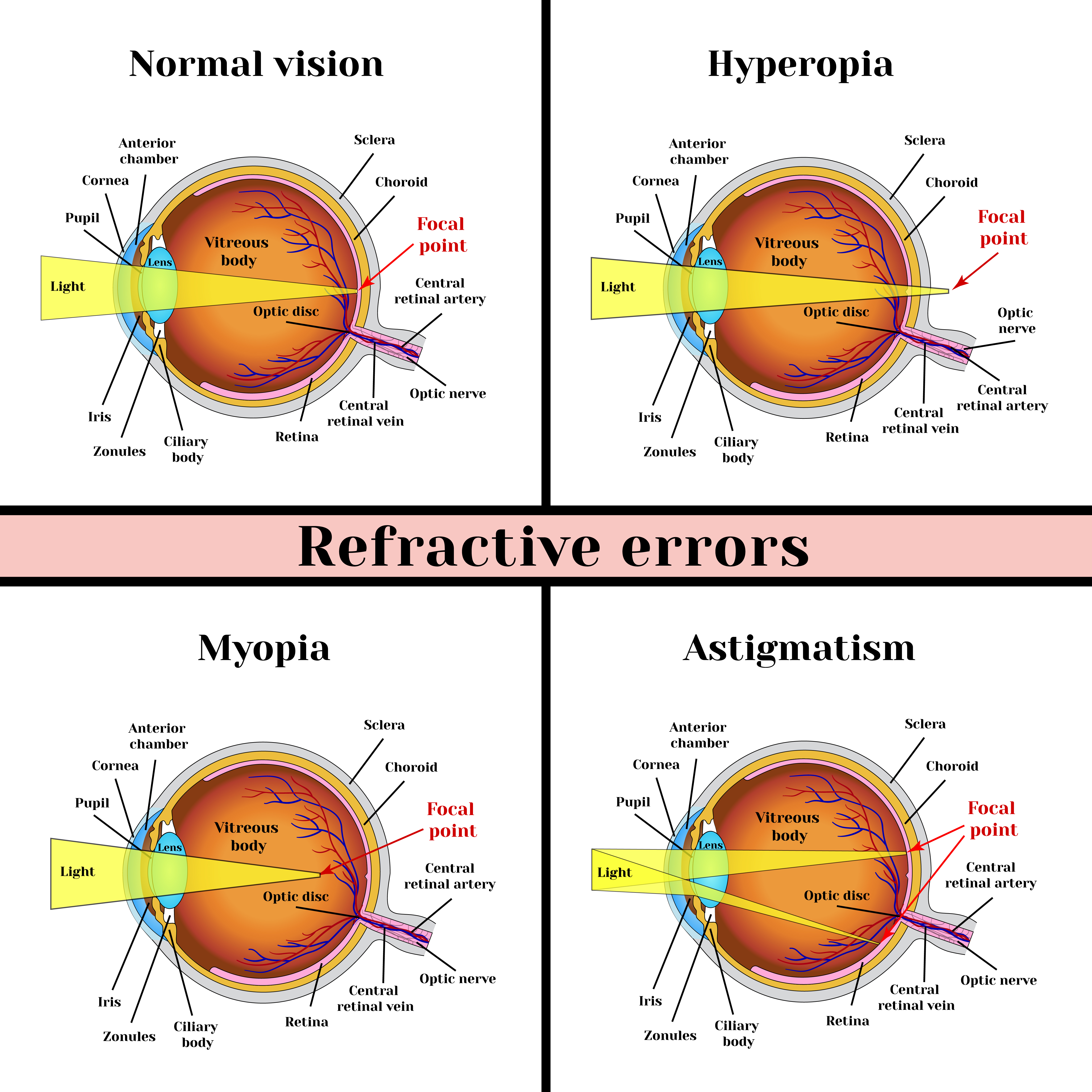 refractive-errors